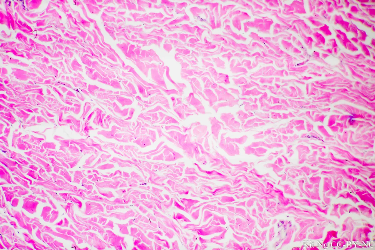 <p>Cells widely separated by thick bands of collagen, few nuclei; thick bands of type I collagen, but fibers randomly oriented</p>