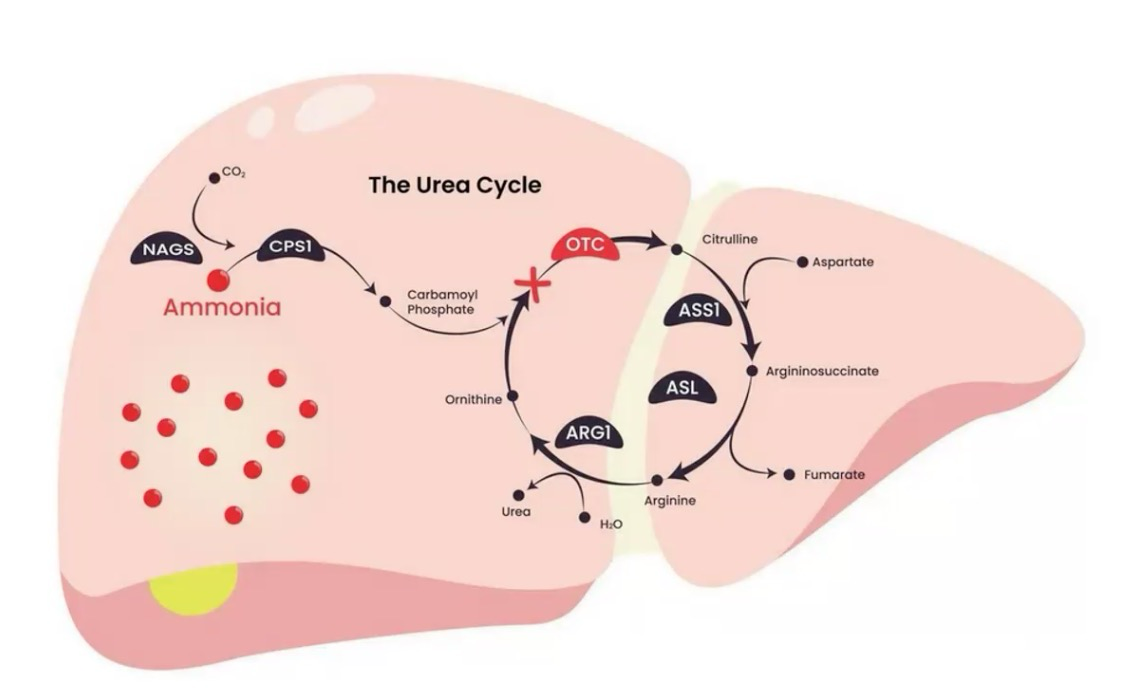 <p>Causes hyperammonemia and orotic aciduria</p><p>Type of UCD; CPS-I assimilates ammonia, but OTC enzyme is deficient and can’t catalyze the first reaction of Urea cycle, causing carbamoyl phosphate and ammonia buildup. This buildup causes leakage into the cytosol, where carbamoyl phosphate turns into orotic acid and causes orotic aciduria</p>