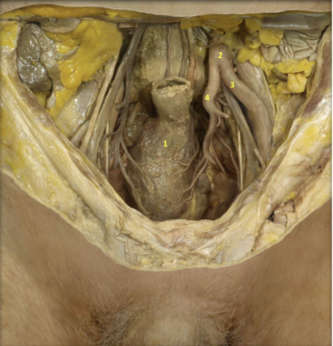 <p>Male Pelvis - Deep Dissection</p><p>1. Rectum</p><p>2. Left common iliac artery</p><p>3. Left external iliac artery</p><p>4. Left internal iliac artery</p>