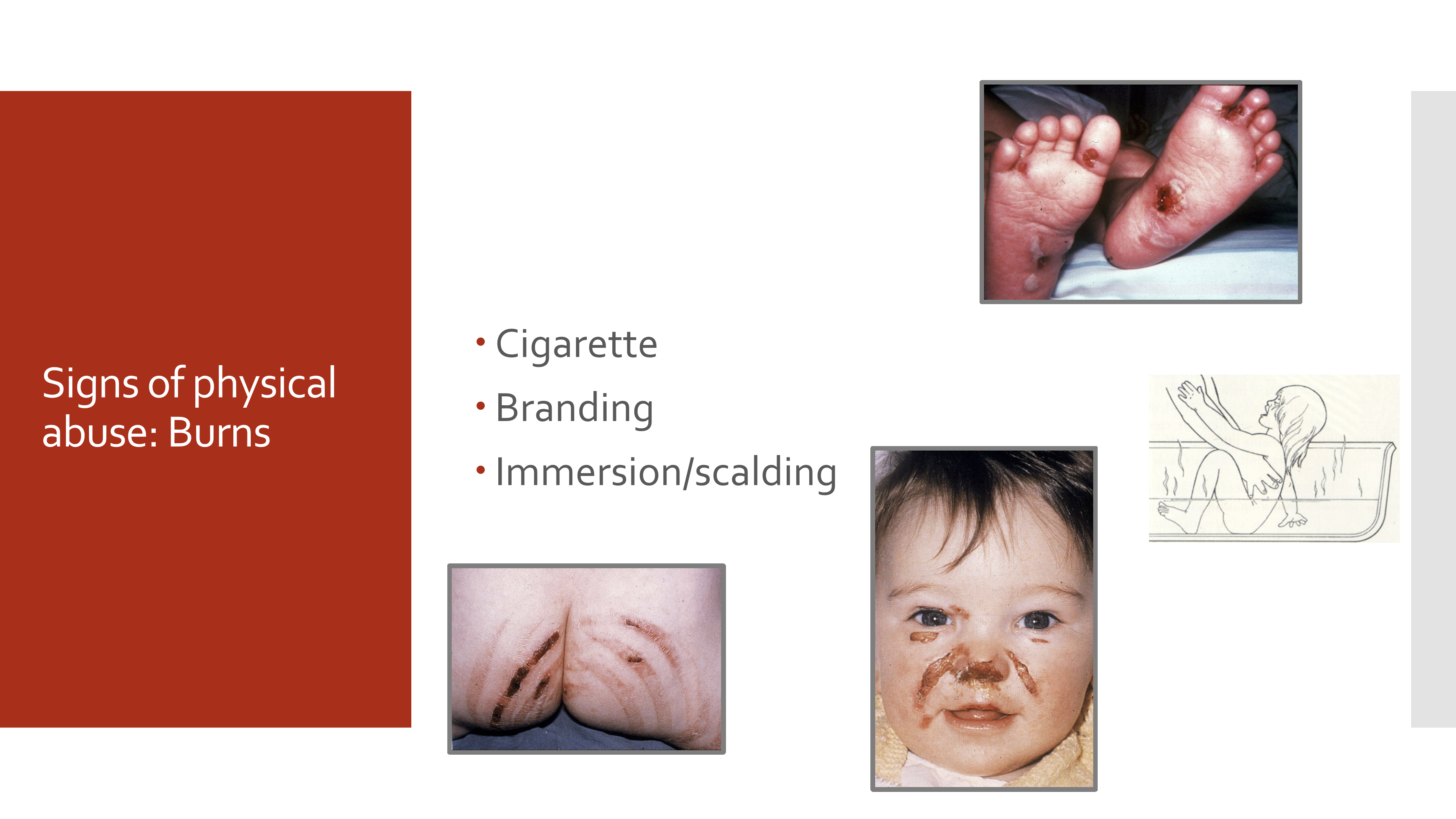 <ul><li><p>Cigarette burns (round, well-demarcated lesions)</p></li><li><p>Branding burns (patterned burns matching an object)</p></li><li><p>Immersion/scald burns with clear lines of demarcation</p></li></ul><p></p>