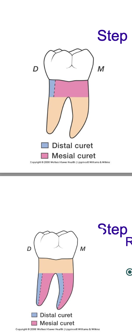 <p>root branches</p><ol><li><p>treat each branch as if its each a tooth</p></li><li><p>distal curet for its distal</p></li><li><p>mesial curet for its mesial</p></li></ol><p></p>