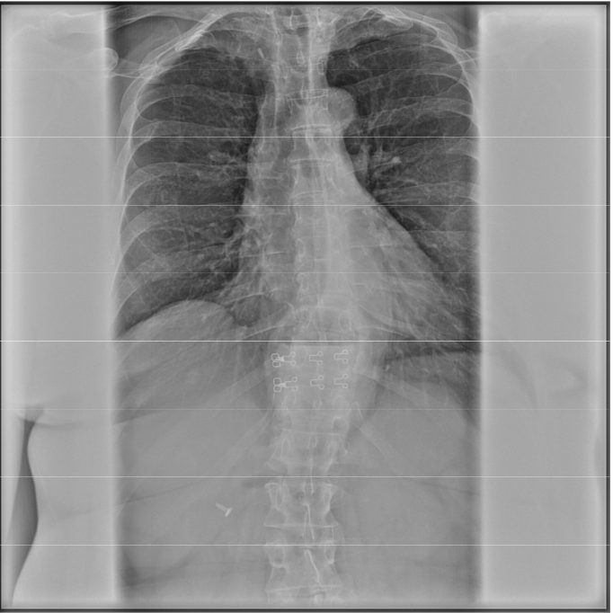 <p>Is this film of diagnostic quality (AP Thoracic)</p>