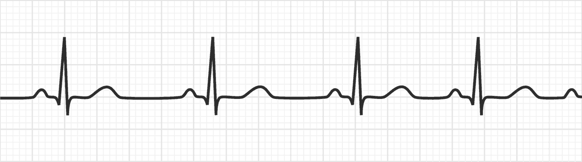 <p><em>Variant of NSR that results from changes in intrathoracic pressure during breathing &amp; meets the following ECG criteria:</em></p><p>i.) <strong>Rate → </strong>Atrial and ventricular rates between 60 and 100 beats/min</p><p>ii.) <strong>Rhythm →</strong> Atrial and ventricular rhythms irregular, with the shortest PP or RR interval varying at least 0.12 second from the longest PP or RR interval</p><p>iii.) <strong>P waves →</strong> One P wave before each QRS complex; consistent configuration</p><p>iv.) <strong>PR interval → </strong>Normal, constant</p><p>v.) <strong>QRS duration → </strong>Normal, constant</p>