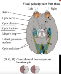 <p>contralateral homonymous hemianopia</p>