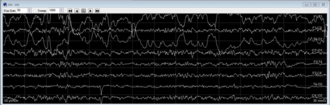 <p>The common electrode showing artifact here is:</p>