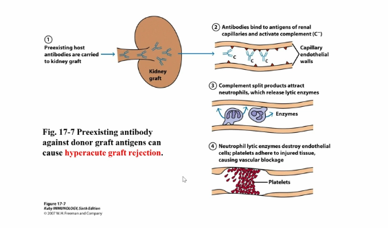 <p>Allogenic Bone Marrow Transplantation + Graft vs Host Disease</p>