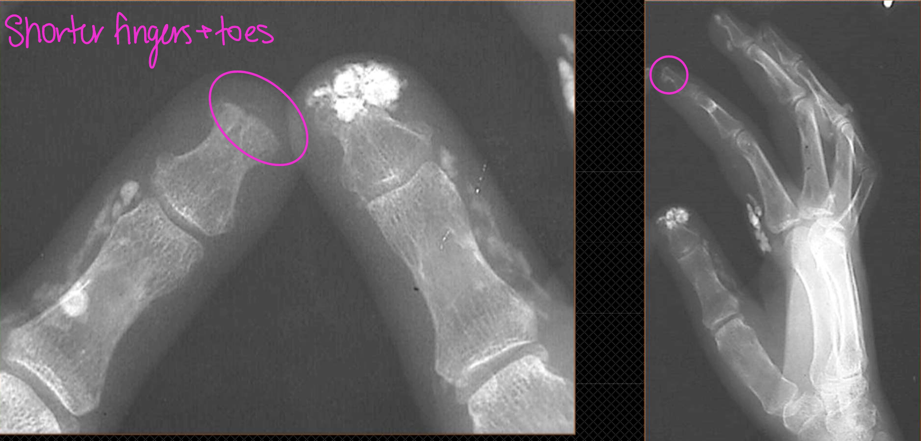 <p>What x-ray finding is present in this pt with Scleroderma (PSS)</p>