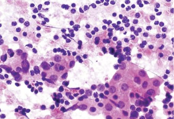 <p>1) Diagnostic cytologique bethesda</p><p>2) Diagnostic </p>