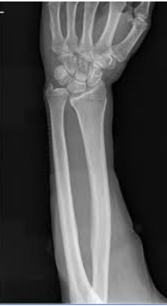 <p>rotura longitudinal de la membrana interosea del antebrazo, fx de la cabeza del radio + lesion de la articulacion rc distal</p>