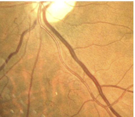<p>Pathophysiology of IRMA (intraretinal microvascular abnormalities)</p>