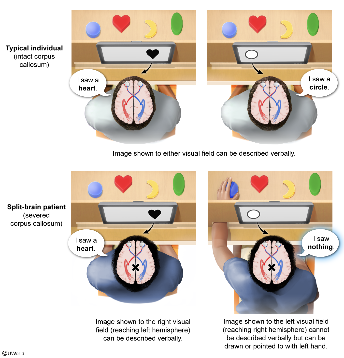 <p><span>The scenarios shown below describe what a typical individual would say they can see on the monitor compared to an individual with a severed corpus callosum.</span></p>