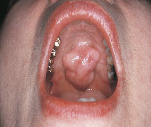 <p>a segment or lobe that is a part of the whole lesion; these lobes sometimes appear fused together </p>