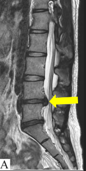 <p>Herniated Nucleus Pulposus</p>