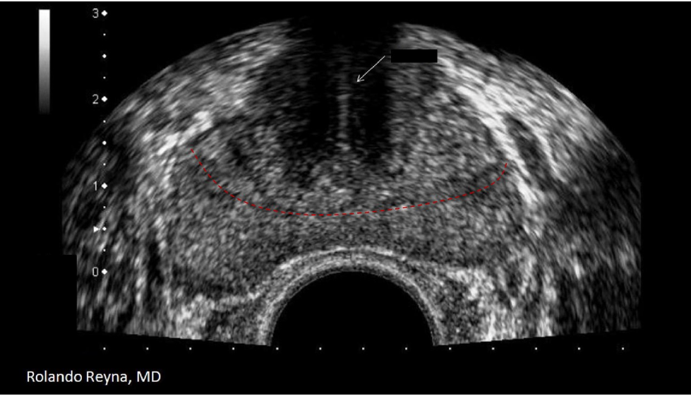 <p>The white arrow on the image indicates:</p><p>A. air tract from biopsy</p><p class="p1">B. central zone</p><p class="p1">C. urinary catheter</p><p class="p1">D. urethra</p>
