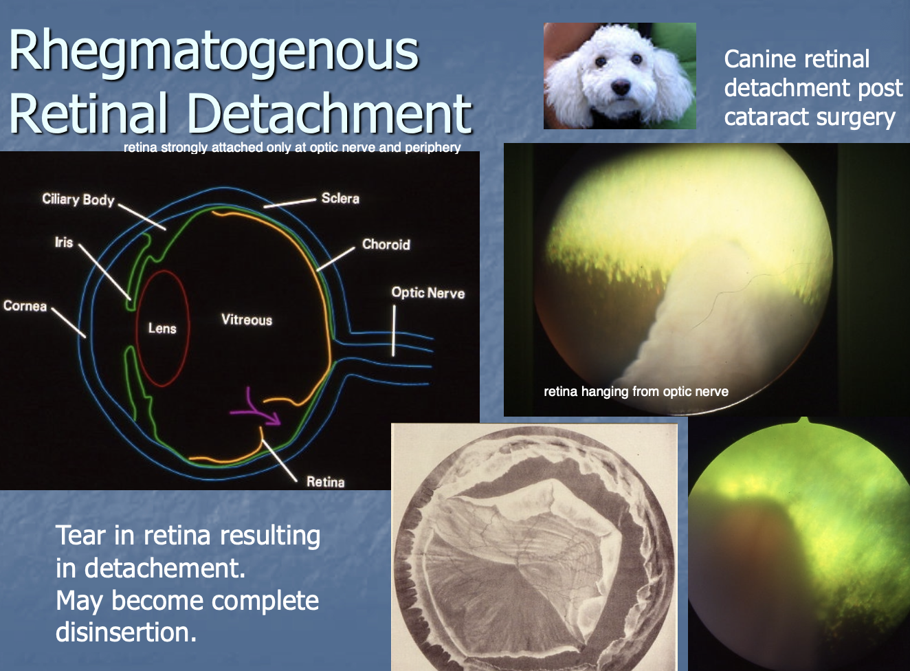 <p>tear in retina resulting in detachment, may become disinsertion.</p>