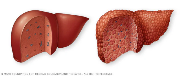 <p>Detection of Hepatic diseases</p><ul><li><p>Primary biliary cirrhosis</p></li><li><p>Primary sclerosing cholangitis</p></li><li><p>Autoimmune hepatitis</p></li><li><p>Etc.</p></li></ul><p></p>