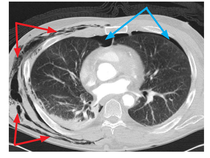 <p>From the blue arrows, what condition is this?</p>