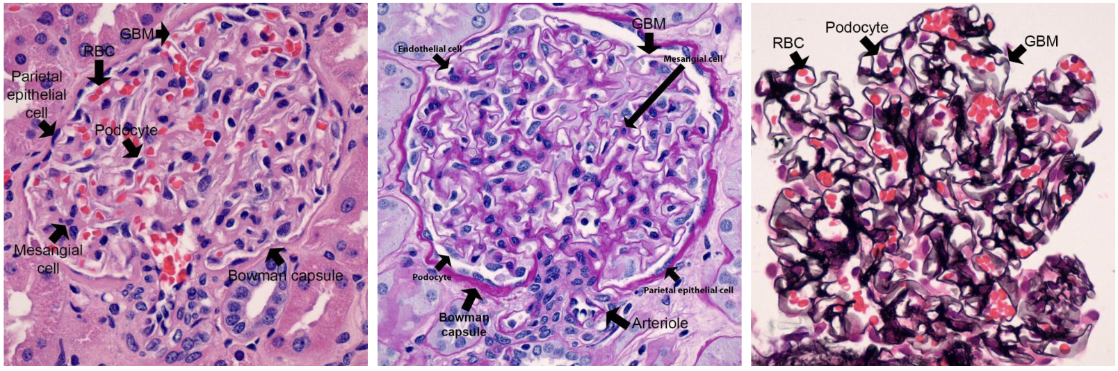<ul><li><p>HE </p><ul><li><p>celkernen → blauw</p></li><li><p>cytoplasma + collageen bw → roze</p></li><li><p>ernstige ontsteking → veel blauwe celkernen te zien </p></li></ul></li><li><p>PAS → lijkt op HE</p><ul><li><p>je ziet ook kapsel van Bowman mooi aankleuren</p></li></ul></li><li><p>zilverkleuring </p><ul><li><p>capilaire wand → scherp zwart randje </p></li><li><p>in de capi kun je de RBC’s zien → zo kun je zien of ontsteking in of uit capi zit </p></li><li><p>podocyten en mesangium kun je ook hiermee onderscheiden </p></li></ul></li></ul><p></p>