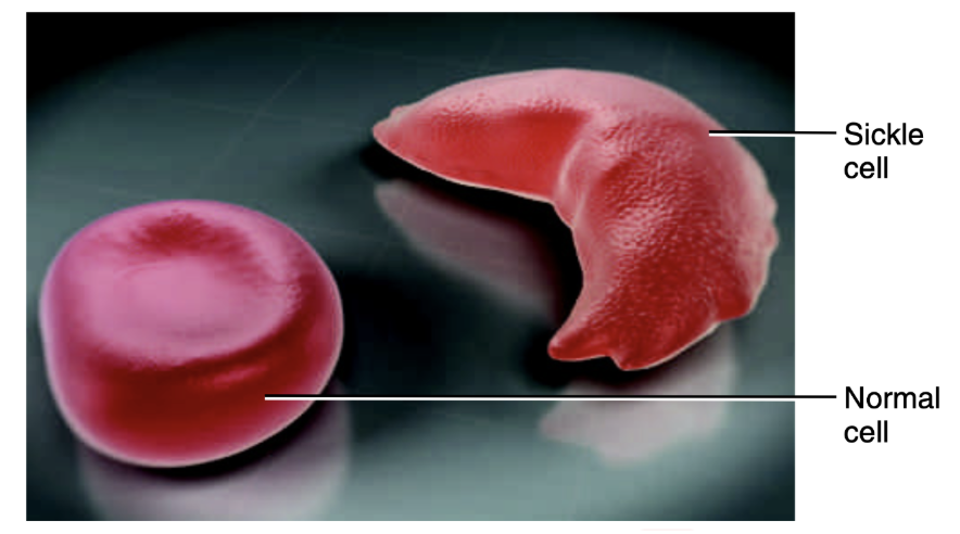 <p>What is sickle cell disease?</p>