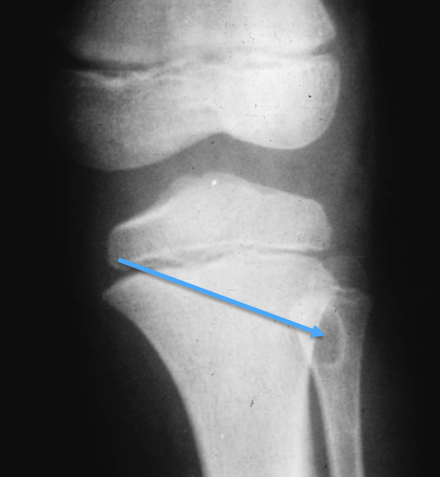 <p>What bone tumour is this, what bone is it in and what can be seen?</p>