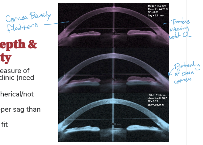 <ul><li><p>The cornea has a deeper sagittal depth</p></li><li><p>This can make soft contact lens fitting more difficult</p></li></ul><p></p>