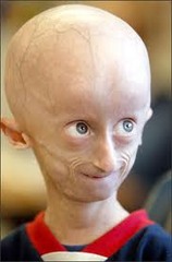 <p>AD (de novo) at LMNA. Limited growth, full-body alopecia, small face with a shallow / recessed jaw and a pinched nose). Progressive wrinkled skin, kidney failure, loss of eyesight, stiff ear canals resulting in conductive hearing loss, and atherosclerosis and other cardiovascular problems, Scleroderma (a hardening and tightening of the skin on trunk and extremities of the body). Small, fragile bodies, like those of older adults. Average age of death 13 years</p>