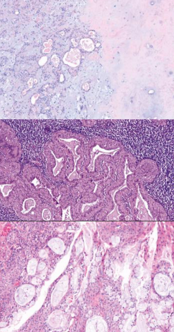 <p>pleomorphic adenoma features? warthin tumor features? mucoepidermoid carcinoma features? </p>