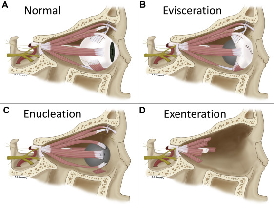 <p><strong>Evisceration</strong></p><ul><li><p>Removal of the contents of the eye within the scleral shell </p></li><li><p>Sclera (white of the eye) remains intact </p></li><li><p>Eye muscles remain attached to the sclera </p></li><li><p>Cosmetic prosthesis is placed </p></li><li><p>Preserved sclera and muscles help provide prosthesis mobility and improved cosmetic appearance </p></li></ul><p><strong>Enucleation</strong></p><ul><li><p>Complete removal of the eyeball (globe) </p></li><li><p>Eye muscles and orbital contents remain intact </p></li></ul><p><strong>Exteneration</strong></p><p>Removal of:</p><ul><li><p>Entire globe (eyeball) </p></li><li><p>Extraocular muscles and supporting orbital structures </p></li></ul><p></p>