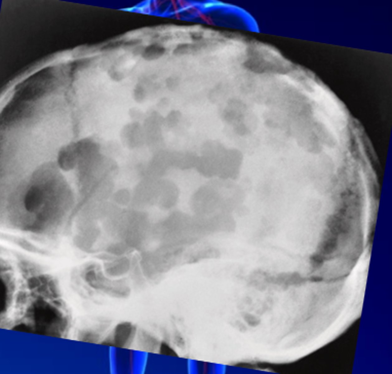 <p>B. Osteomyelitis</p>