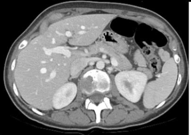 <p>follows arterial phase, begins 1 min after injection</p><p>contrast still in artery, vein, organ parenchyema</p>