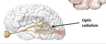 <p><strong>Q:</strong> What type of tract is the optic radiation?<br></p>