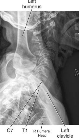 <ul><li><p>CR to T1</p></li><li><p>Vertebral bodies and intervertebral disk spaces of C5 to T3 are shown</p></li><li><p>Humeral head and arm farthest from the IR are magnified and appear inferior to T4 or T5</p></li><li><p>Minimal vertebral rotation indicated by superimposition of cervical zygapophyseal joints and articular pillars, and posterior ribs</p></li><li><p>Humeral heads should be separated vertically</p></li></ul><p></p>