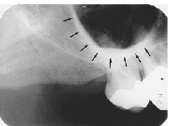 <p>Zygomatic Arch</p>