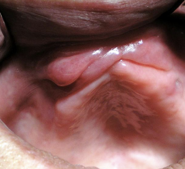 <p>Surface Texture : a term used to describe the surface texture of a lesion </p>