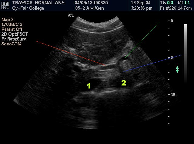 <p><strong>The red line is pointing to</strong></p><p>The main portal vein</p><p>The hepatic artery</p><p>The splenic vein</p><p>The SMA</p>