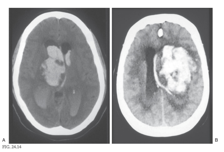 <p>A second type of posturing frequently observed in human patients is referred to as <strong>decorticate posturing </strong>or <strong>decorticate rigidity </strong>( Figs. 24.9D and 24.10D ). The clinical events that lead to this type of posturing are frequently large lesions of the cerebral hemisphere ( Fig. 24.14 ). These may be vascular or rapidly growing tumors that are located in one hemisphere, damage major tracts on that side, efface the midline, and compromise tracts on the opposite side by mass effect and compression. The net result is a removal of cortical influence on brainstem motor nuclei.</p><p>In the clinic, the patient presents with flexion of the upper extremities (intact rubrospinal fibers) at the elbow combined with extensor hypertonus in the lower extremities (intact reticulospinal fibers), an altered state of consciousness and respiration, oculomotor deficits, and a range of motor responses from weakness to motionless ( Fig. 24.15 ).</p>