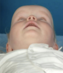 <p>premature fusing of the skull bones</p><p>scaphocephaly, plagiocephaly, oxycephaly</p>