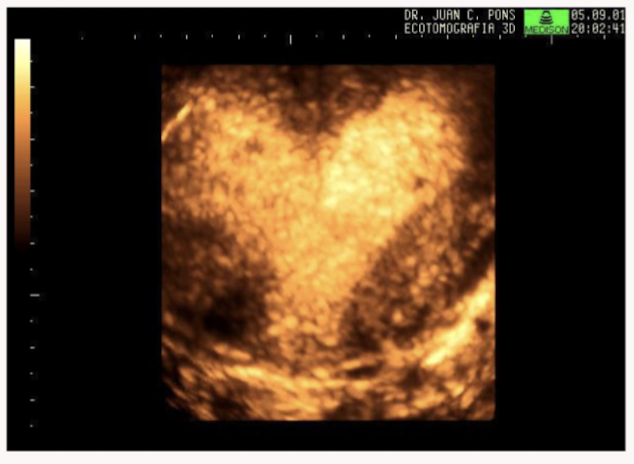 <p>Name the uterine anomaly </p>