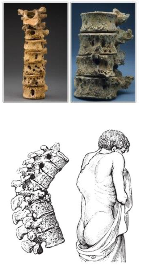 <p>Pathology: Inflammatory or Infectious Disease Example: Tuberculosis (TB)</p>