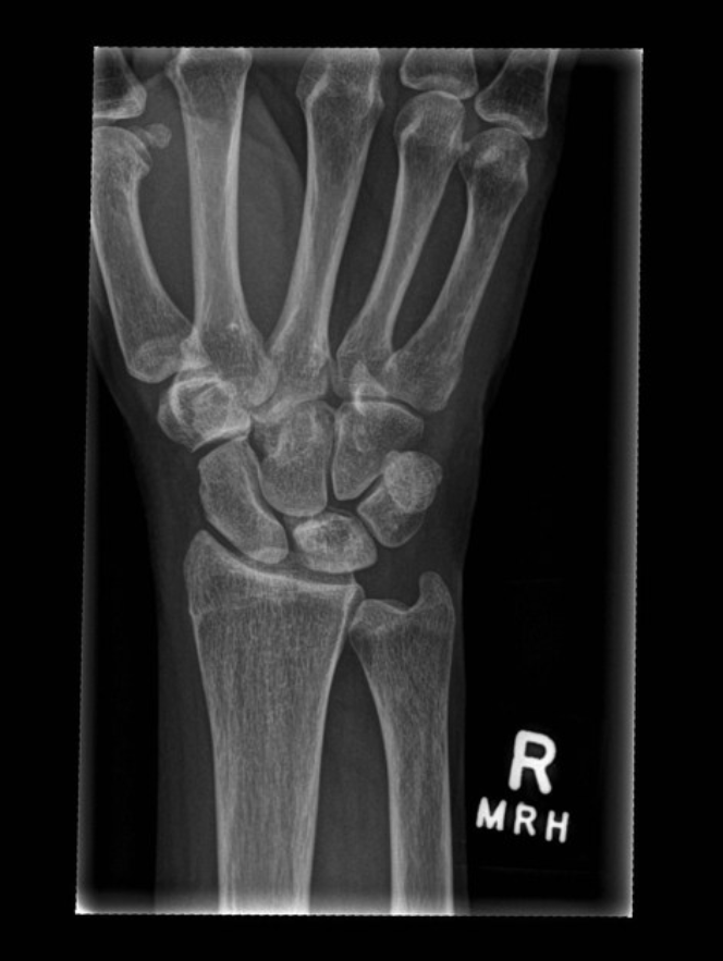 <p>AVN of the carpal lunate </p>