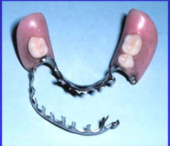 <p>ID the type of mandibular major connector:</p>