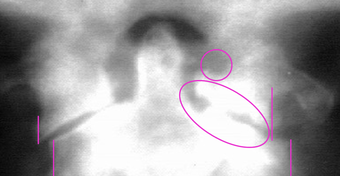 <p>What finding of cervical RA is in this image</p>