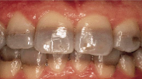 <p>What drug caused this discoloration?</p>