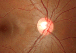 <p>blinde spot</p>