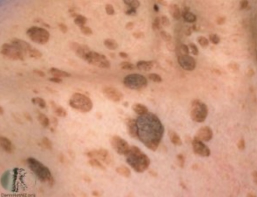 <p>Benign “”barnacles of aging”</p><ul><li><p>waxy, pasted-on look</p></li></ul><p></p>