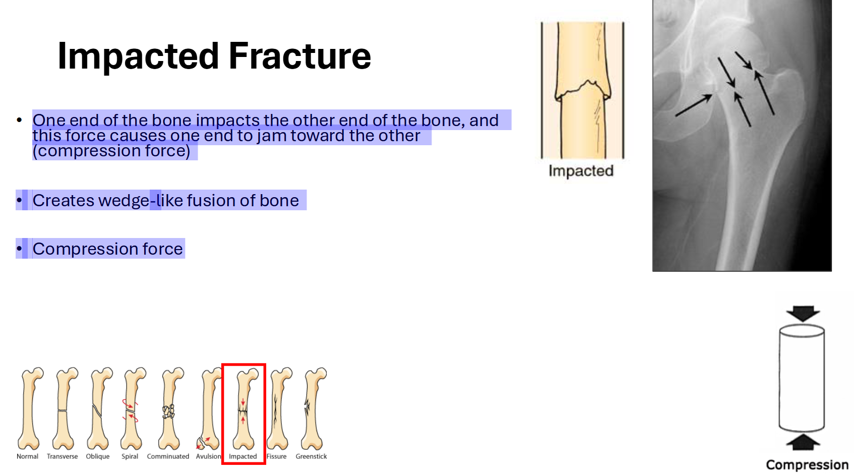 <p>Impacted Fracture</p>