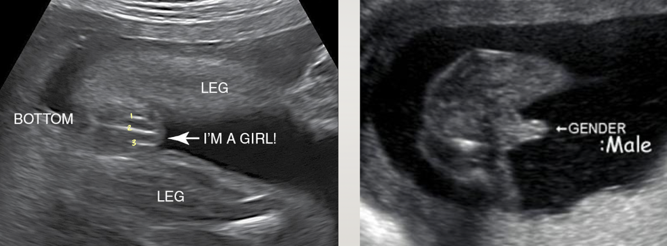 <p>male</p><ul><li><p>both scrotum and penis identified</p></li><li><p><span style="color: red;">“turtle sign”</span></p></li></ul><p>female</p><ul><li><p>vulva/labia lips identified</p></li><li><p><span style="color: red;">“three-line sign”</span></p></li><li><p><span style="color: red;">“hamburger sign”</span></p></li></ul><p></p>