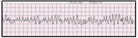 <p>Identify the above waveform:</p><p>a. asystole</p><p>b. monitor malfunction </p><p>c. A fib</p><p>d. V fib</p>