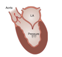 <p>What is aortic stenosis?</p>