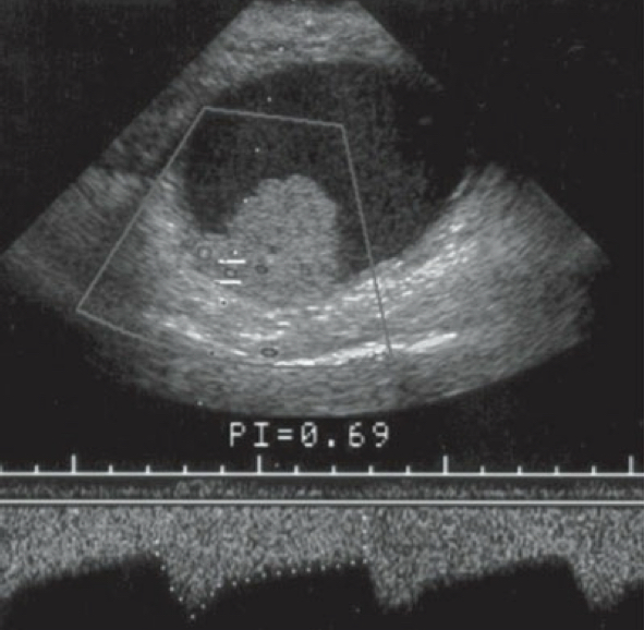 <p>This is an example of a ____ resistance waveform seen with ovarian ____ </p>